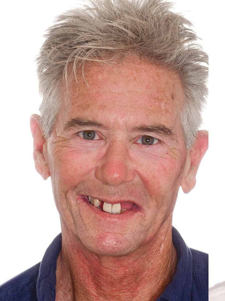 Before dental implant restoration