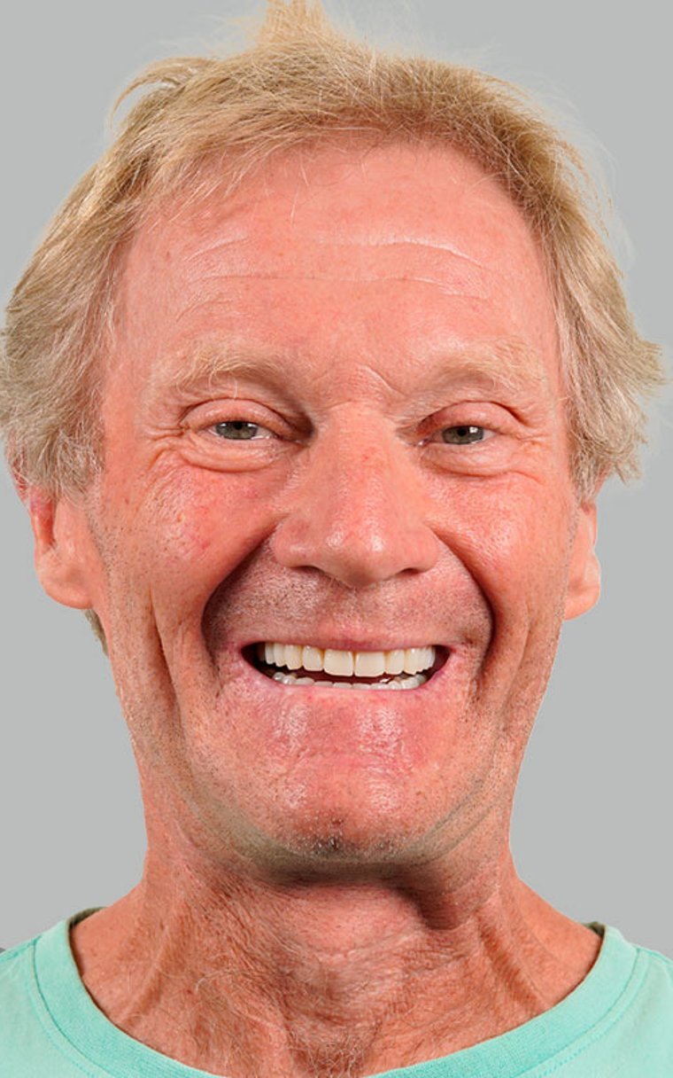 After All-on-4 dental implants