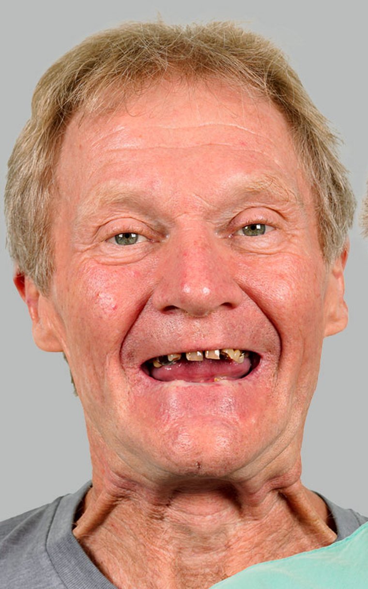 Before All-on-4 dental implants