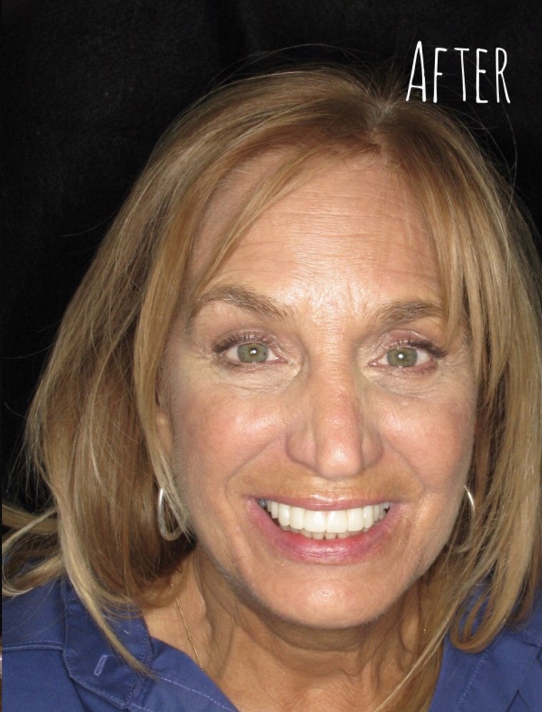 After full mouth reconstruction