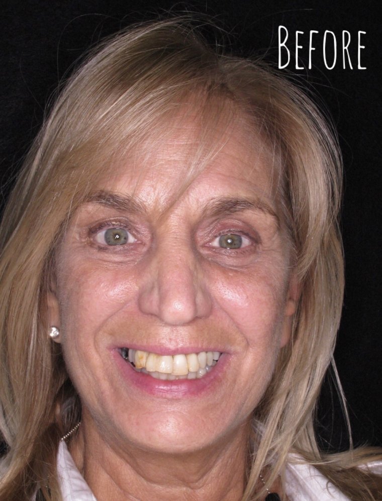Before full mouth reconstruction