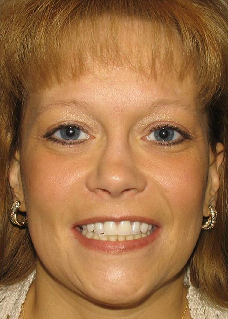 After cosmetic dental makeover