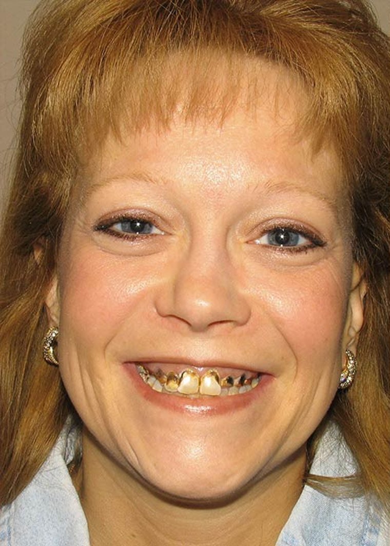 Before cosmetic dental makeover